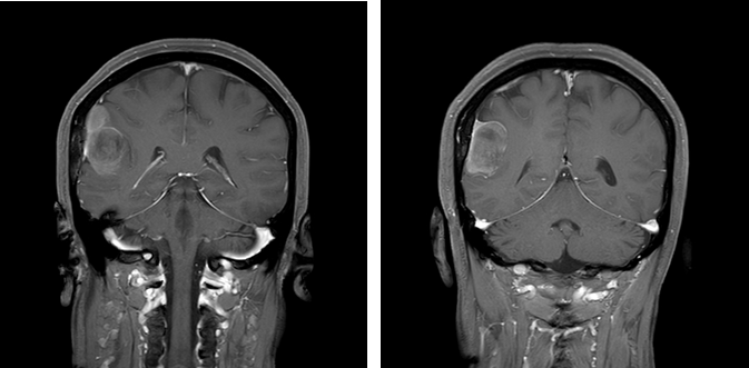 脑膜瘤与血管外皮瘤的 MRI 诊断与鉴别诊断 脑膜瘤与血管外皮瘤的 MRI 诊断与鉴别诊断