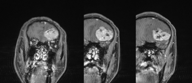 脑膜瘤与血管外皮瘤的 MRI 诊断与鉴别诊断 脑膜瘤与血管外皮瘤的 MRI 诊断与鉴别诊断