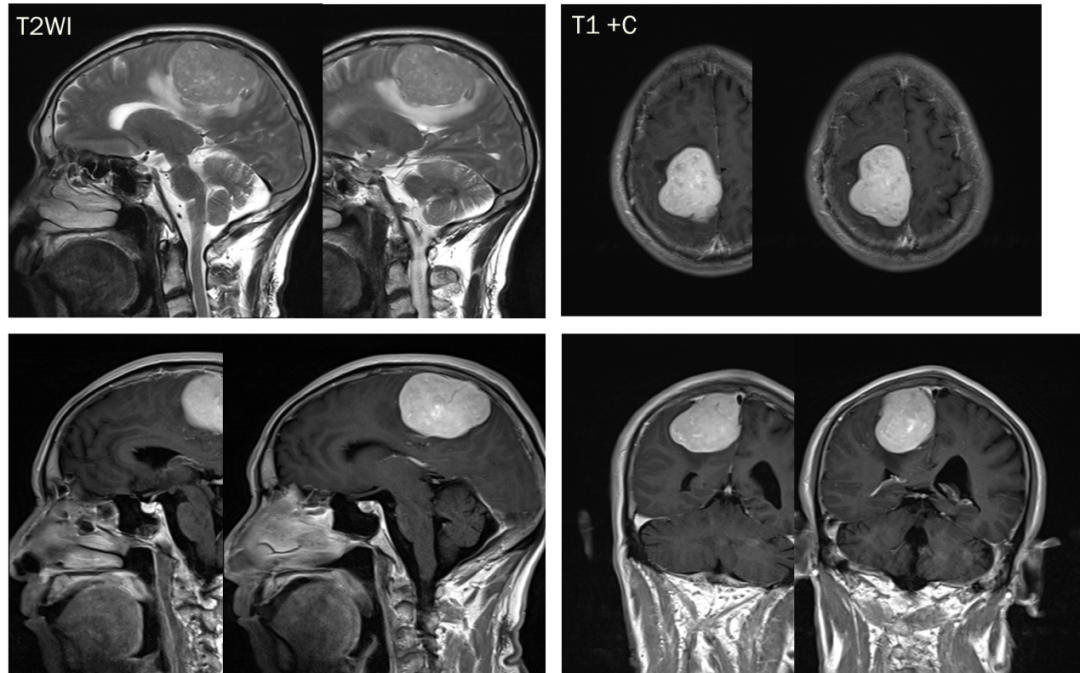 脑膜瘤与血管外皮瘤的 MRI 诊断与鉴别诊断 脑膜瘤与血管外皮瘤的 MRI 诊断与鉴别诊断