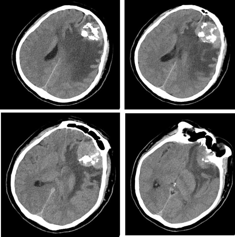 脑膜瘤与血管外皮瘤的 MRI 诊断与鉴别诊断