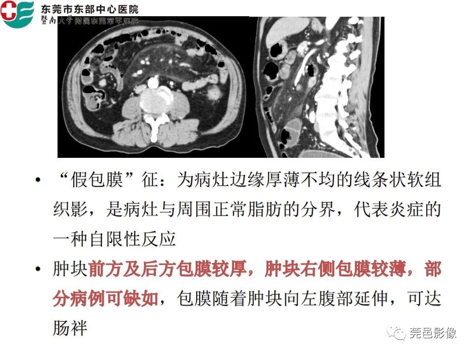 【PPT】肠系膜脂膜炎的CT表现