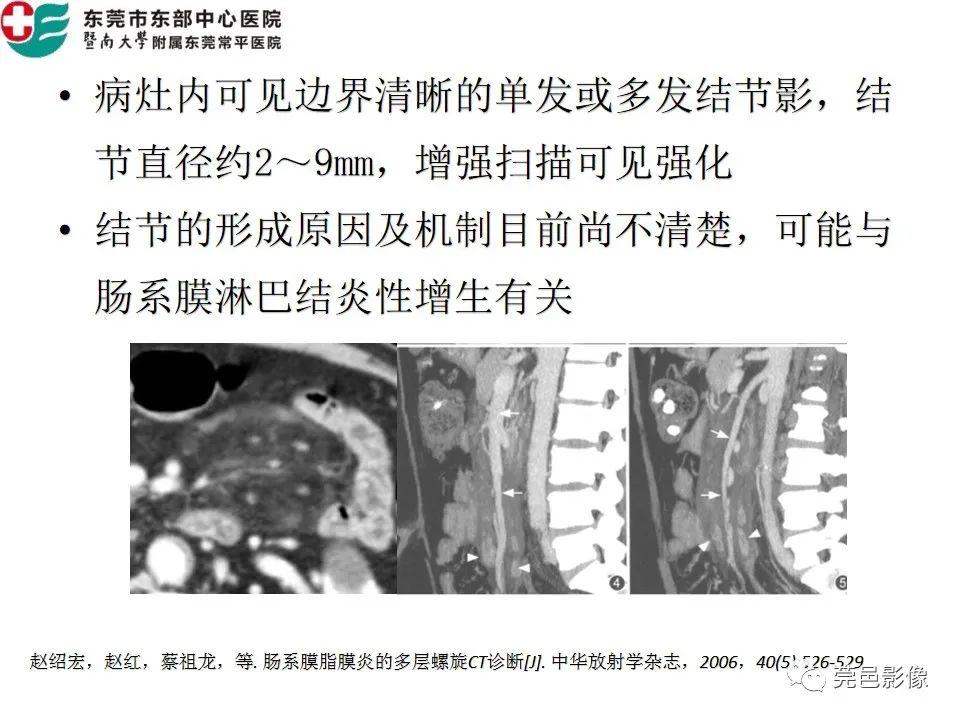 【PPT】肠系膜脂膜炎的CT表现