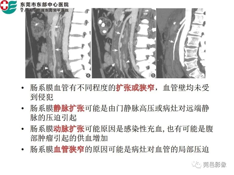 【PPT】肠系膜脂膜炎的CT表现