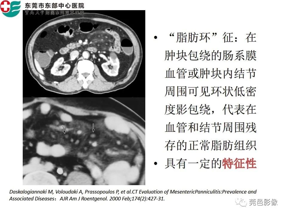 【PPT】肠系膜脂膜炎的CT表现