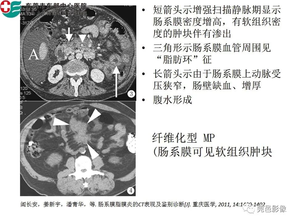 【PPT】肠系膜脂膜炎的CT表现