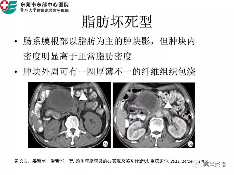 【PPT】肠系膜脂膜炎的CT表现