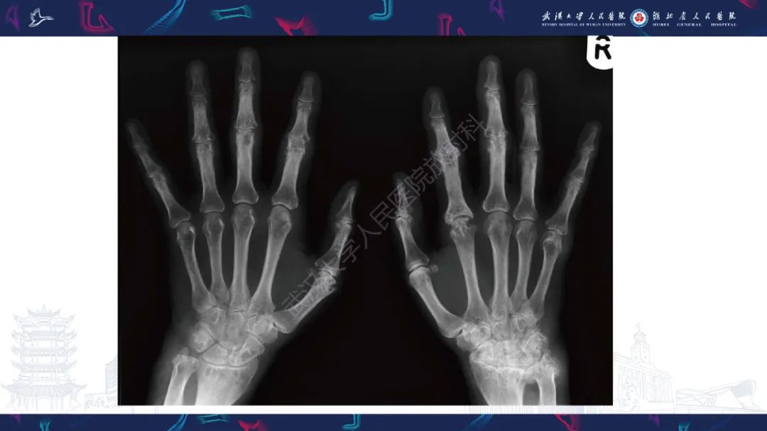 【PPT】关节痛风影像诊断