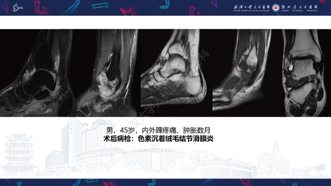 【PPT】关节痛风影像诊断