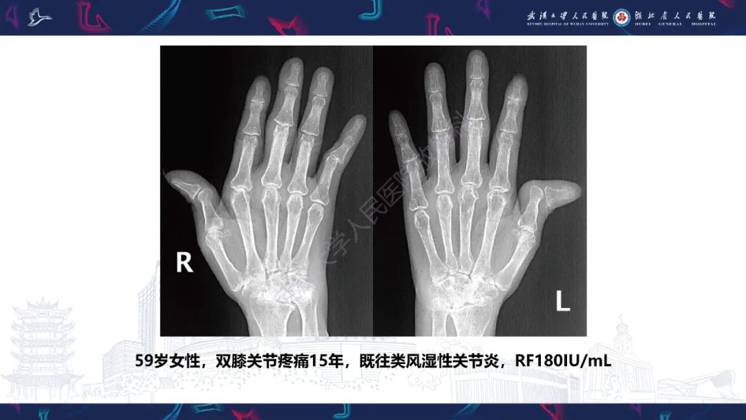 【PPT】关节痛风影像诊断