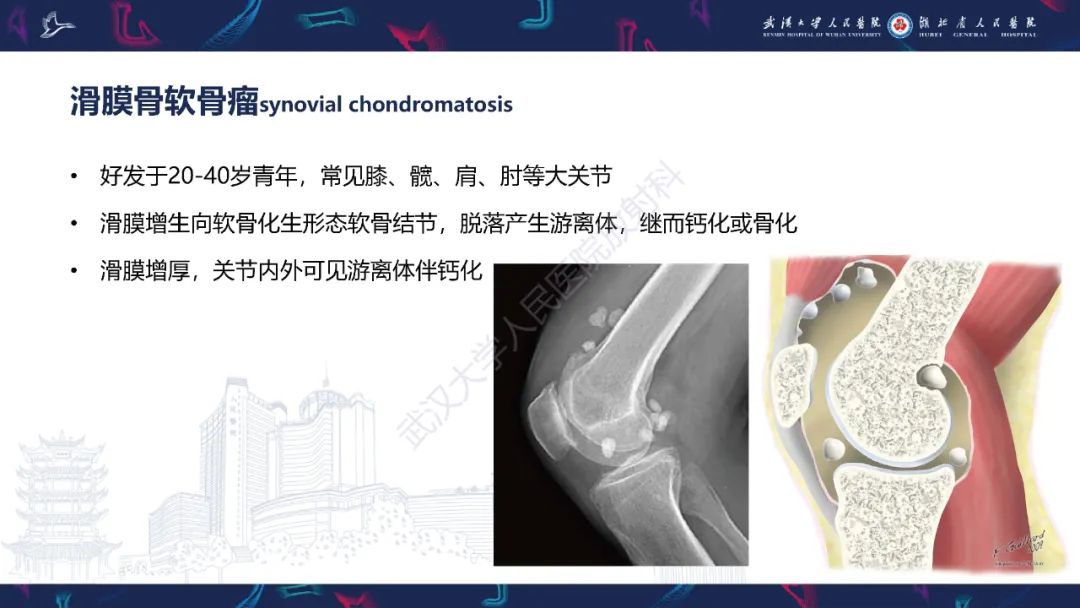 【PPT】关节痛风影像诊断