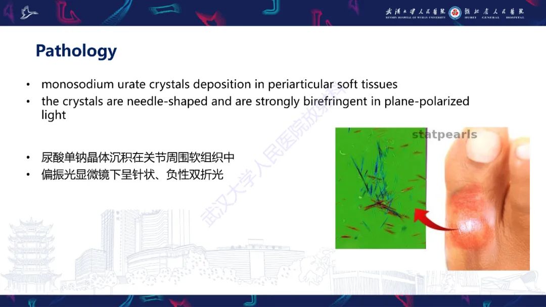 【PPT】关节痛风影像诊断