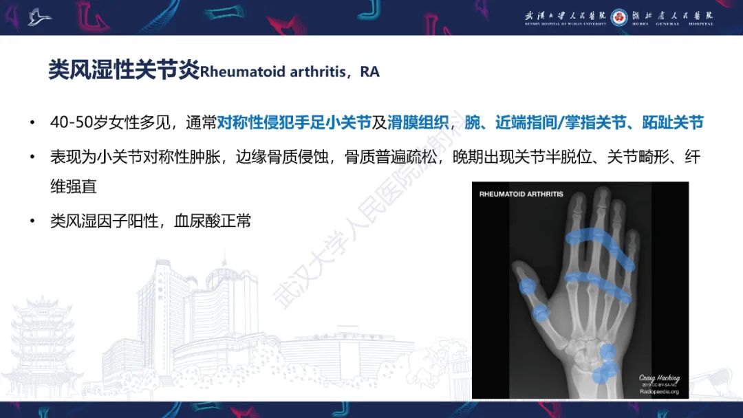 【PPT】关节痛风影像诊断
