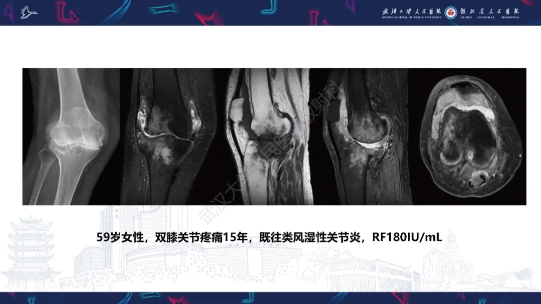 【PPT】关节痛风影像诊断