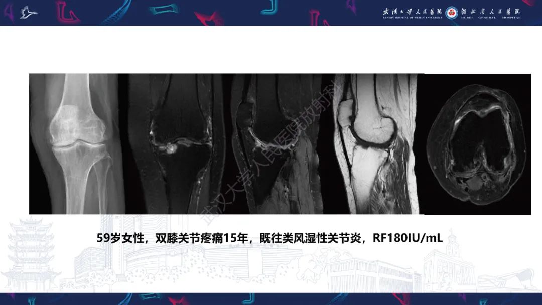 【PPT】关节痛风影像诊断