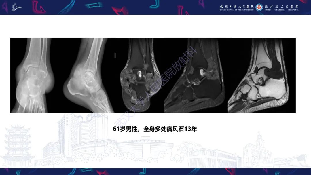 【PPT】关节痛风影像诊断