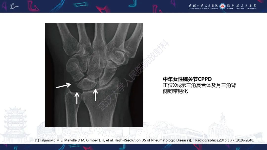 【PPT】关节痛风影像诊断