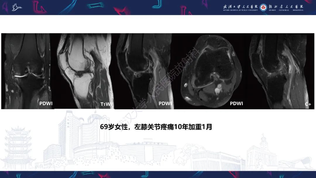 【PPT】关节痛风影像诊断