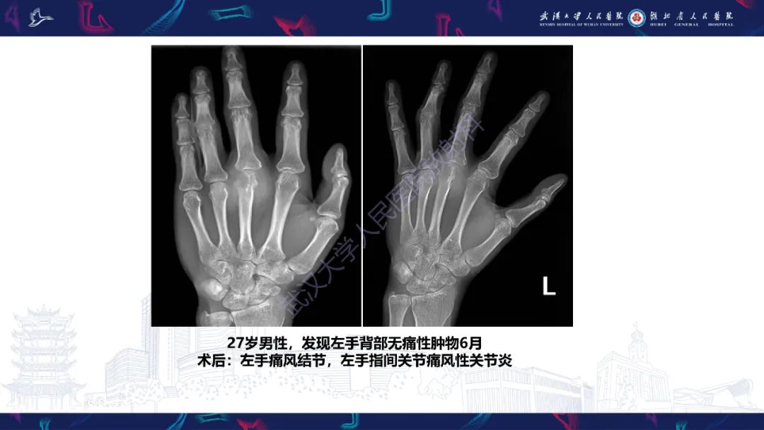 【PPT】关节痛风影像诊断