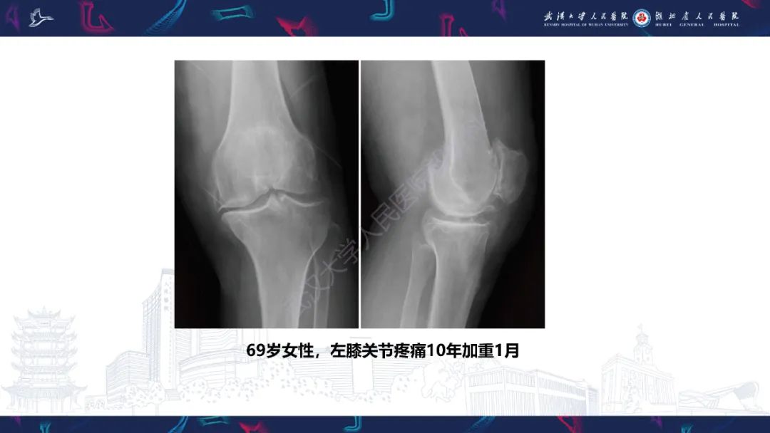 【PPT】关节痛风影像诊断