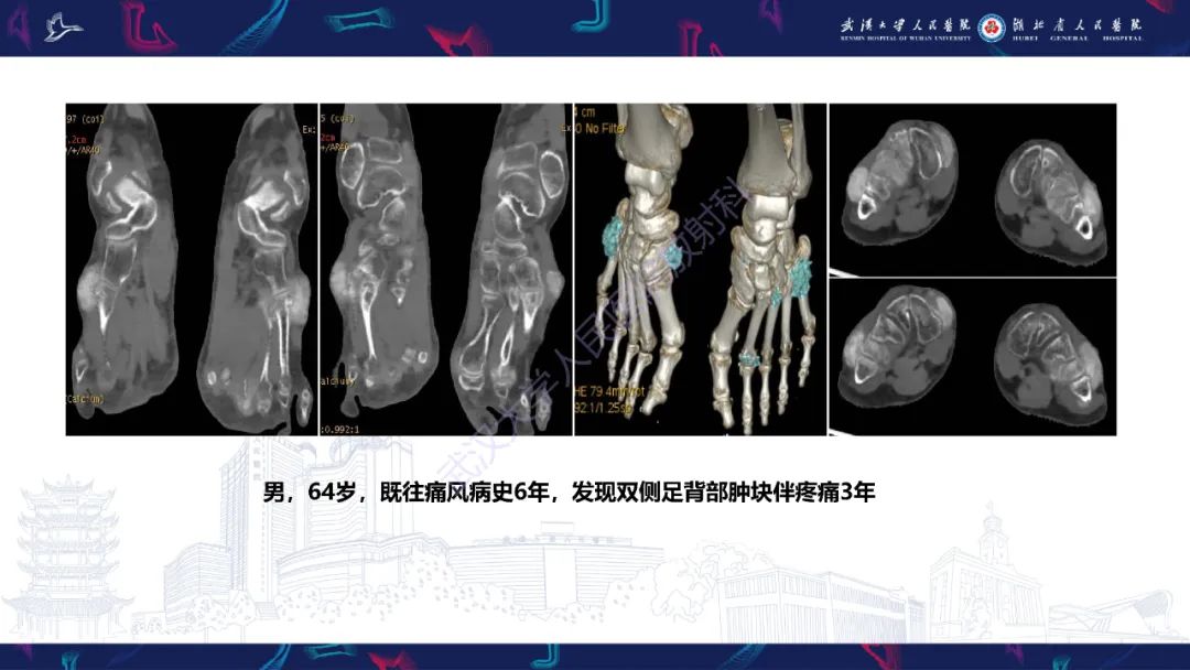 【PPT】关节痛风影像诊断