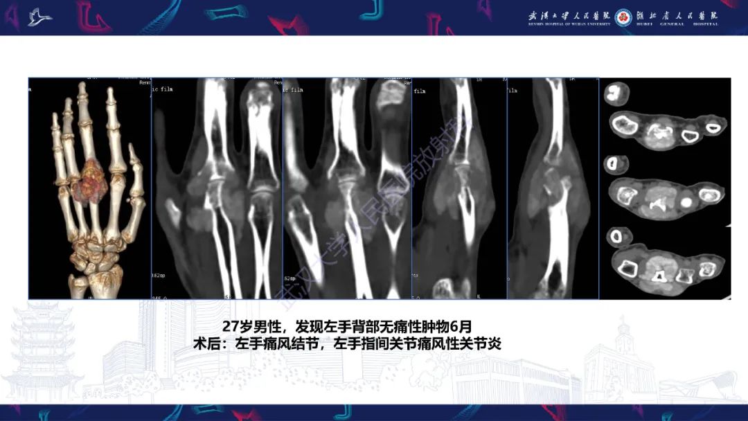 【PPT】关节痛风影像诊断