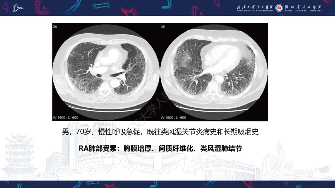 【PPT】关节痛风影像诊断