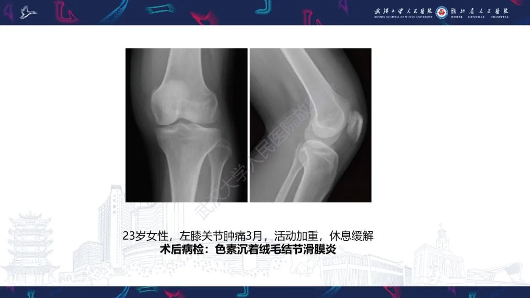 【PPT】关节痛风影像诊断