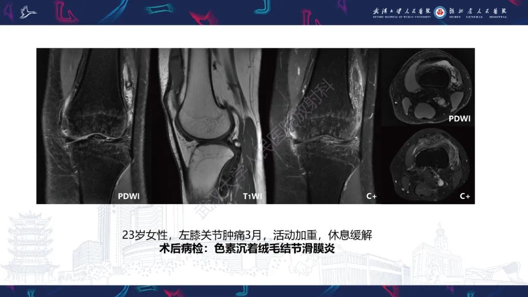 【PPT】关节痛风影像诊断