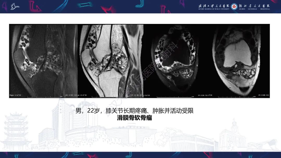 【PPT】关节痛风影像诊断