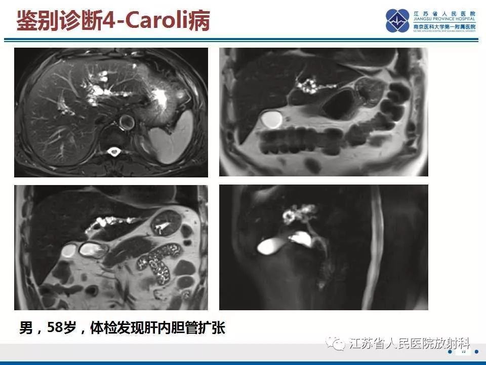 【病例】复发性化脓性胆管炎1例CT及MR影像