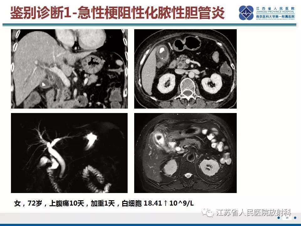 【病例】复发性化脓性胆管炎1例CT及MR影像