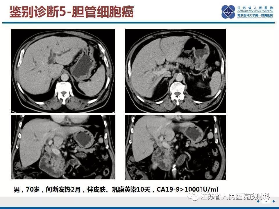 【病例】复发性化脓性胆管炎1例CT及MR影像