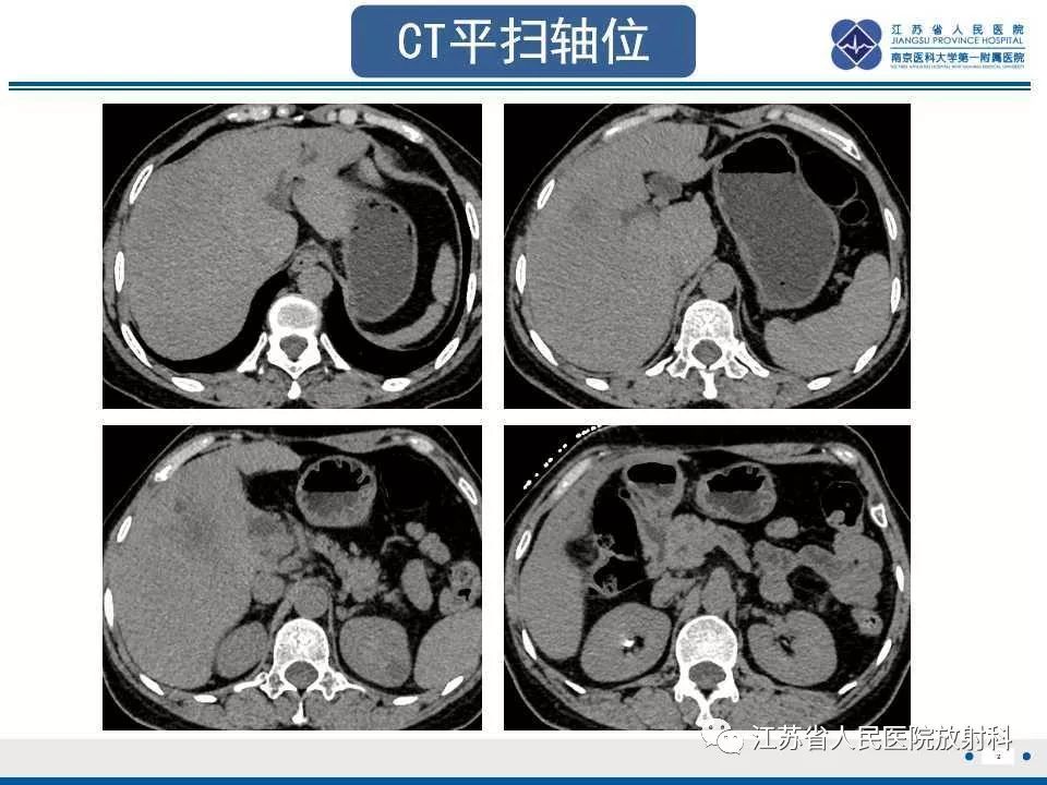 【病例】复发性化脓性胆管炎1例CT及MR影像
