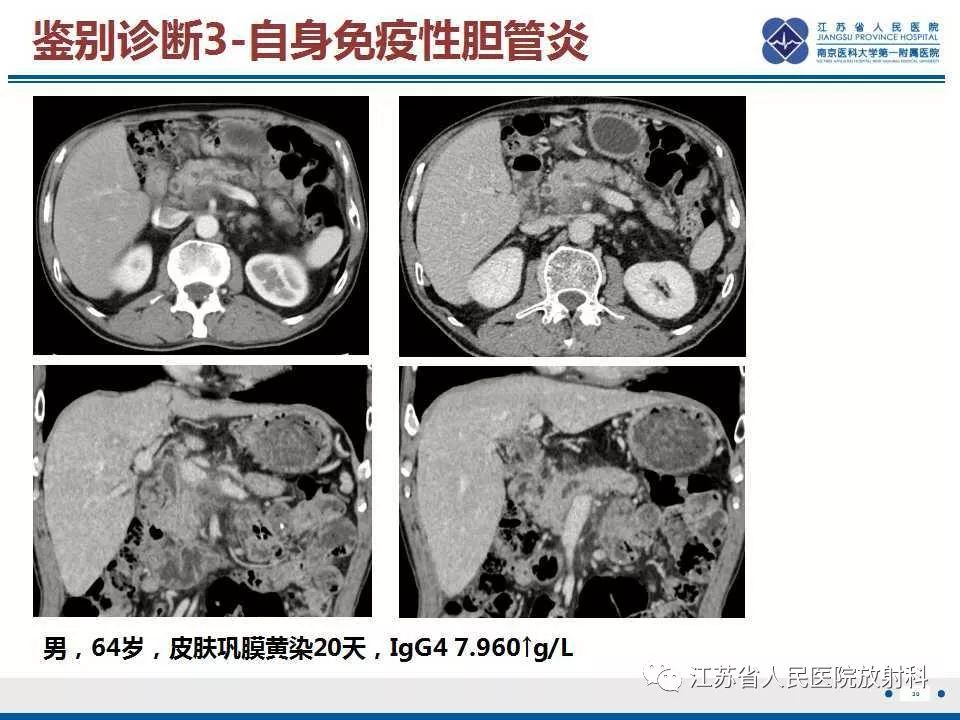 【病例】复发性化脓性胆管炎1例CT及MR影像