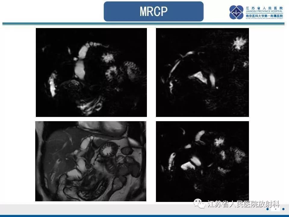 【病例】复发性化脓性胆管炎1例CT及MR影像