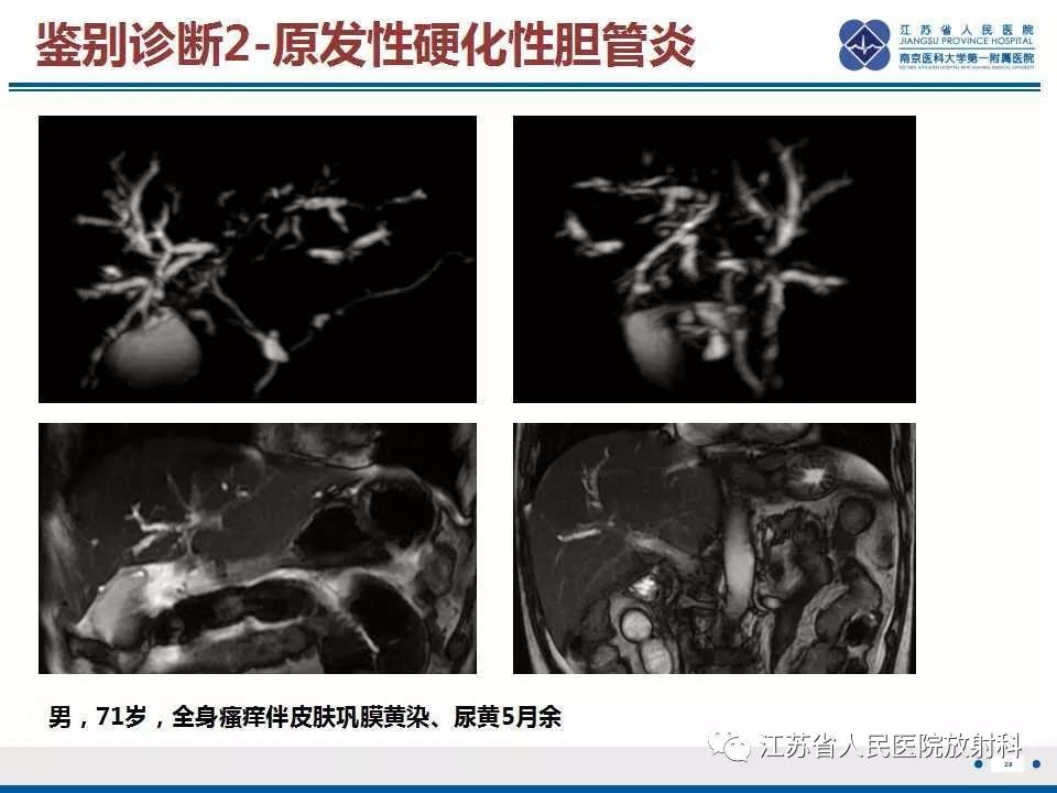 【病例】复发性化脓性胆管炎1例CT及MR影像