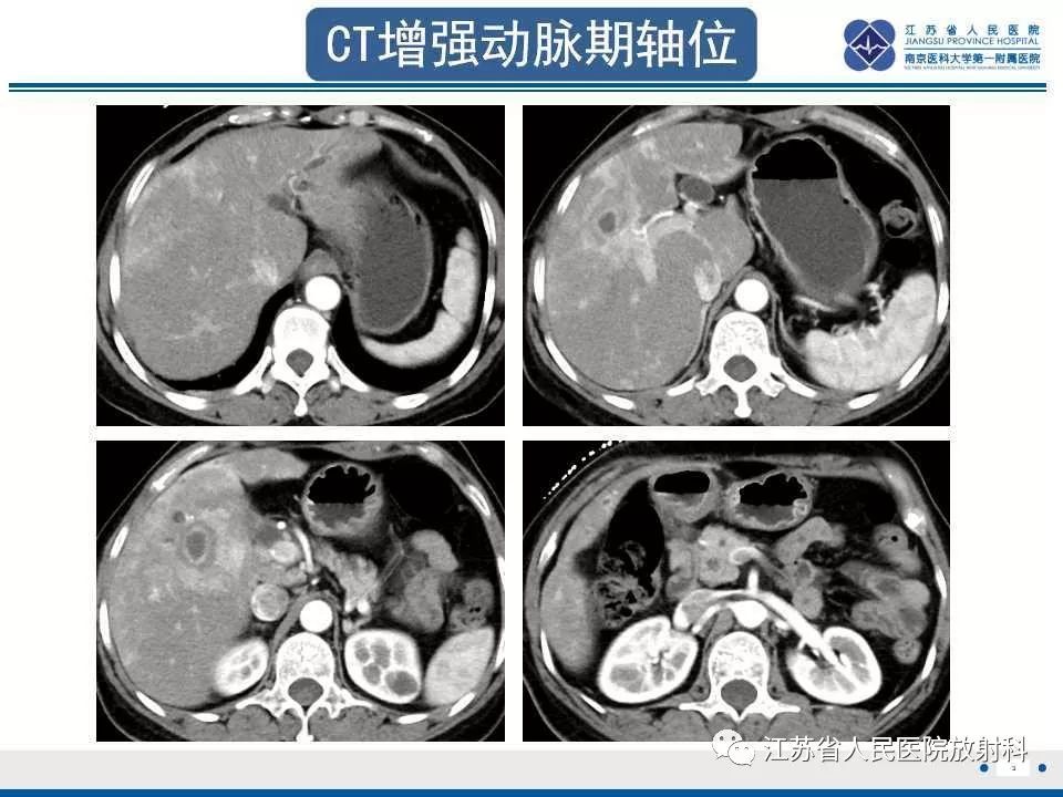 【病例】复发性化脓性胆管炎1例CT及MR影像