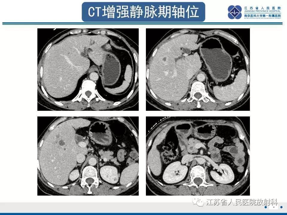 【病例】复发性化脓性胆管炎1例CT及MR影像