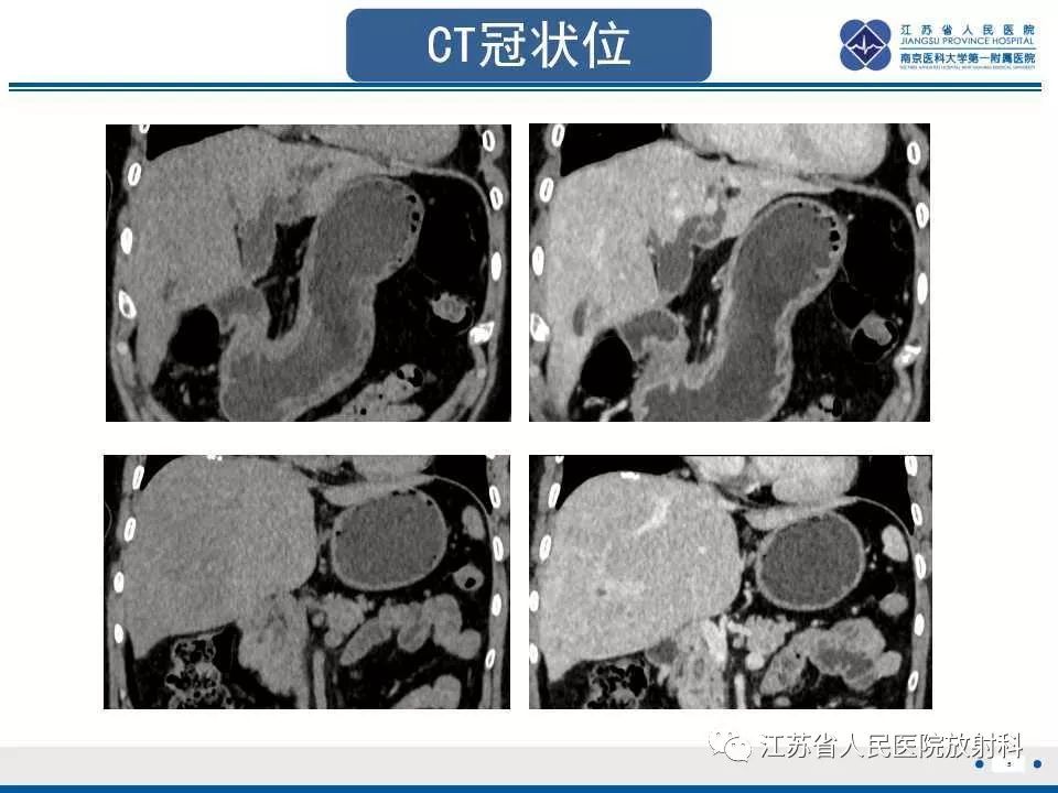 【病例】复发性化脓性胆管炎1例CT及MR影像
