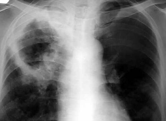 【病例】肺鳞癌肺内转移1例X线CT