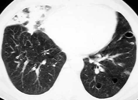 【病例】肺鳞癌肺内转移1例X线CT