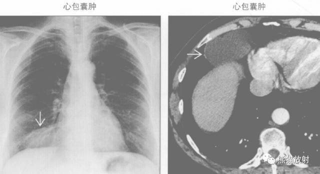 “纵隔囊性肿块”的鉴别诊断