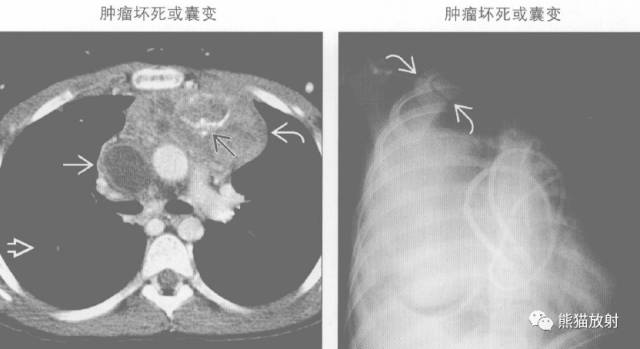 “纵隔囊性肿块”的鉴别诊断