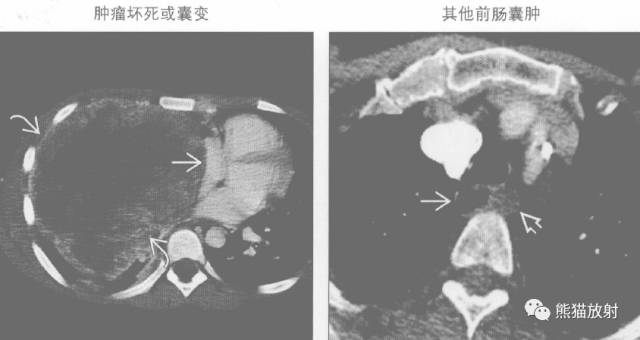 “纵隔囊性肿块”的鉴别诊断