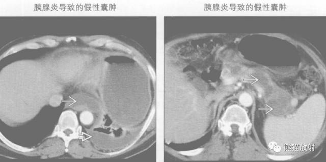 “纵隔囊性肿块”的鉴别诊断