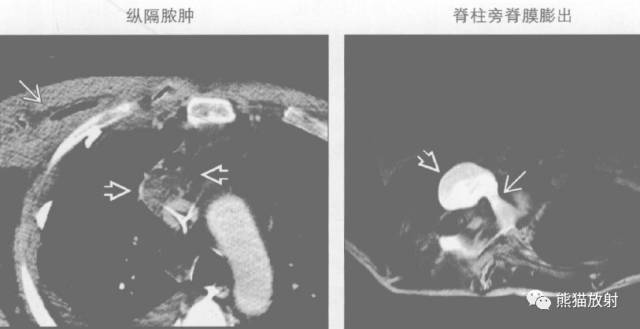 “纵隔囊性肿块”的鉴别诊断