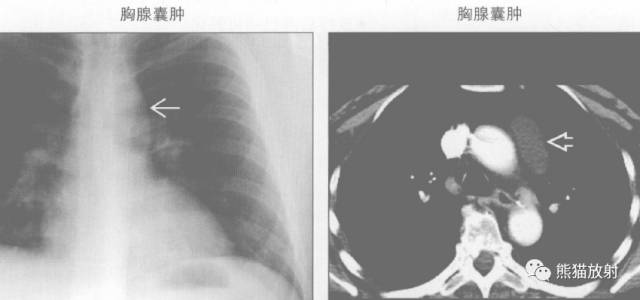 “纵隔囊性肿块”的鉴别诊断