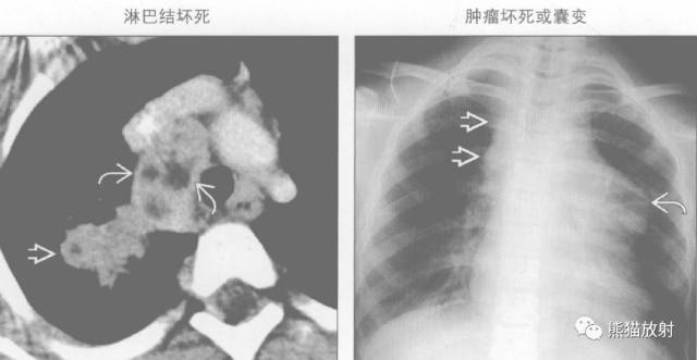 “纵隔囊性肿块”的鉴别诊断