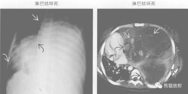 “纵隔囊性肿块”的鉴别诊断