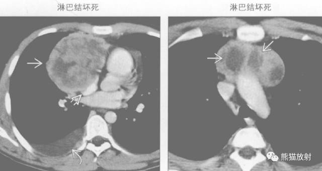 “纵隔囊性肿块”的鉴别诊断
